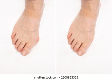 Hallux Valgus Deformity Of The Big Toe Caused By Wearing Uncomfortable Shoes. Elderly Woman's Foot Before And After Treatment Isolated On A White Background. Orthodontics