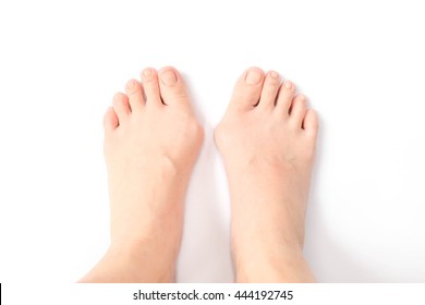 Hallux Valgus, Feet Isolated On White. Hallux Valgus Is A Medical Term For Bunion Foot / Bunionette. Hallox Valgus Is Normally Caused By Genetic And/or Wearing Too Tight Shoes & High Heels.