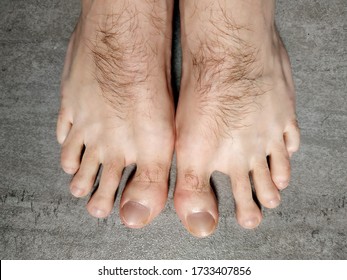 Hallux Valgus Man With Hairy  Toe And Foot