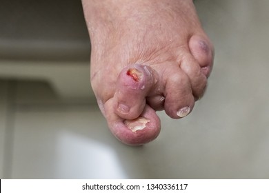 Hammer Toe And Bunion With Pressure Ulcer