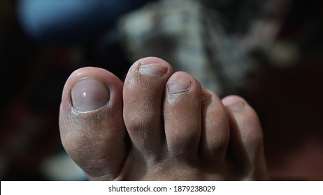 Hammer Toe Close Up Of Adult Male 