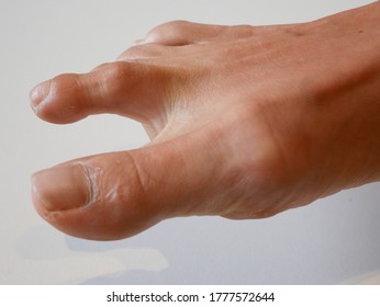 Hammertoe Condition Of A Woman's Foot. 