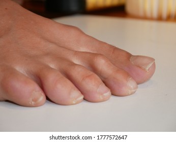 Hammertoe Condition Of A Woman's Foot. 