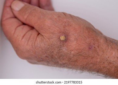 Hand of a 75-year-old Caucasian man with wart or cutaneous horn, which is an outgrowth of compact keratin. - Shutterstock ID 2197783315