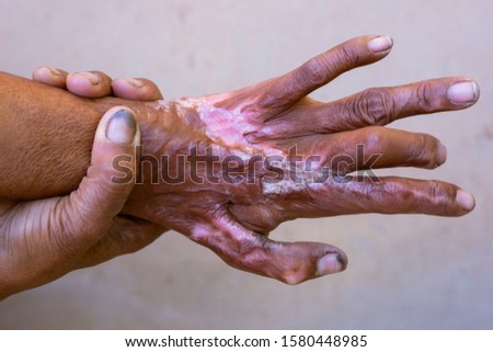 The hand of an accidentally disabled person,Hand scar, wrinkled skin, dirty hands