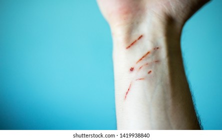 Cat Scratch Disease Images, Stock Photos & Vectors | Shutterstock