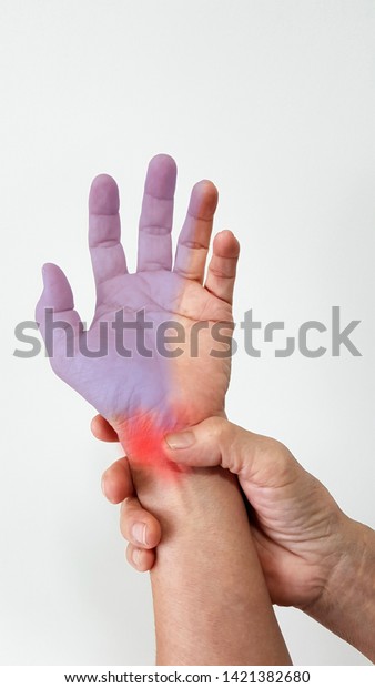 Hand anatomy. The patient suffer from  symptom\
wrist pain (red highlight), numbness and tingling(blue highlight)\
from carpal tunnel syndrome disease(CTS, median nerve entrapment).\
medical problem.