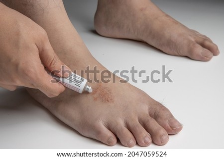 hand applying medication cream, gel or ointment on foot infected by ringworm, athlete's foot or tinea pedis fungal infection. on white background.