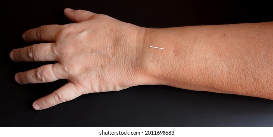 Hand And Arm With Acupuncture Needle On The Triple Warmer Meridian.