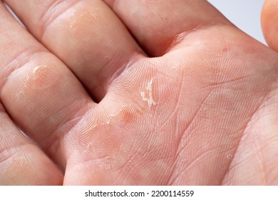 Hand With Blister And Callus Close Up.