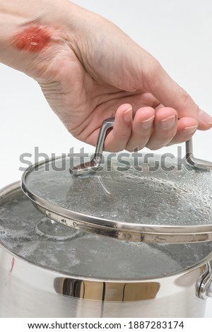 Woman’s hand with burns by hot steam holds lid of pot with boiling water, burns of skin,  home accident concept, careless behavior with boiling water and hot steams, scalds on a skin