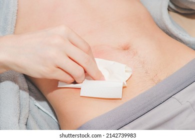 The hand of a caucasian young man is pressed with a sterile dry napkin on the small intestine brought out on the stomach, top view .Concept step-by-step replacement of a colostomy bug at home, abdomin