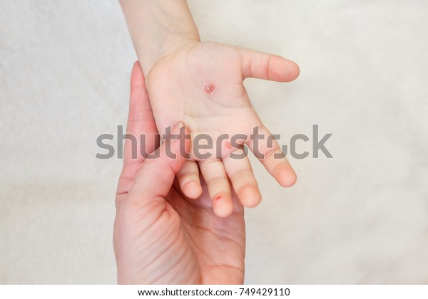 母親の手に水痘を持つ子供の手 水疱瘡の手の水疱 の写真素材 今すぐ編集