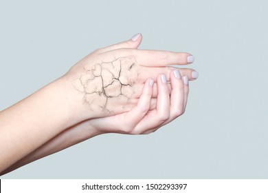 Hand With Cracked Skin. Skin Care In Winter, Moisturizing The Skin