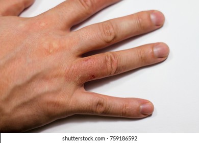 dermatitis herpetiformis bilder