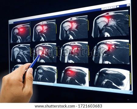 Hand doctor point MRI of shoulder Explain the results to the patient to know rotator cuff tendon tear red highlight focus