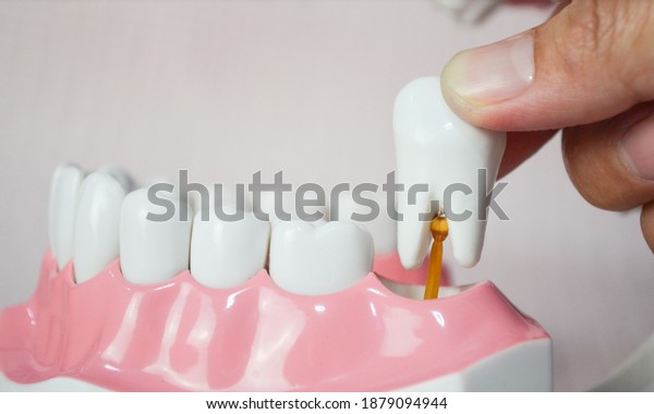 Hand extracting a molar tooth
,Hand pulling out a molar tooth ,Hand drawing a molar tooth .
