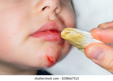 Hand Of A Father Who Disinfects A Laceration And Abrasive Burn In The Face Of A Young Toddler With Swedish Bitters, A Herbal Medicine 