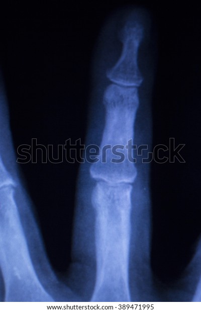 Hand Fingers Injury Orthopedic Traumatology Medical Stock Photo