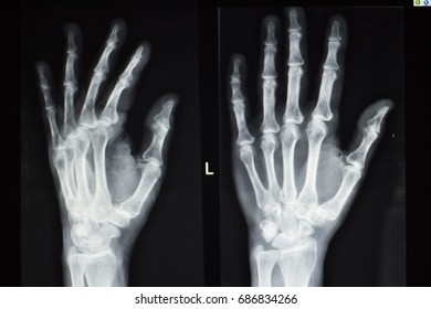 Hand Fingers Joint Xray Test Scan Results Of  Patient With Arthritis And Joints Pain In Hands.