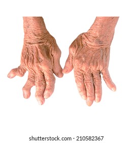 Hand And Fingers Of Patient Of Gout. Isolated On White With Path. The Local Clinic Diagnosed Inability To Treat The Disease At This Stage. Intense Pain In A Night Without Warning Looks Like Gout.