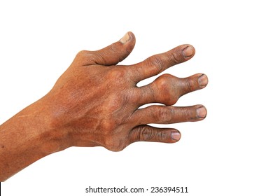 Hand And Fingers Of Patient Of Gout.  Isolated On White With Path