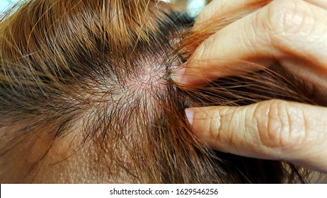 Hand Or Fingers Scratch On Red Skin Head.  Tinea Capitis Or Dandruff Concept.