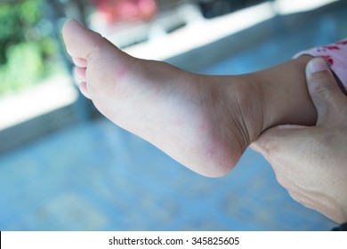 Hand Foot Mouth Disease In Child