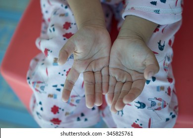 Hand Foot Mouth Disease In Child