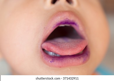 Hand Foot Mouth Disease In Child