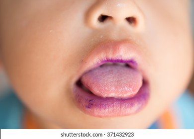 Hand Foot Mouth Disease In Child