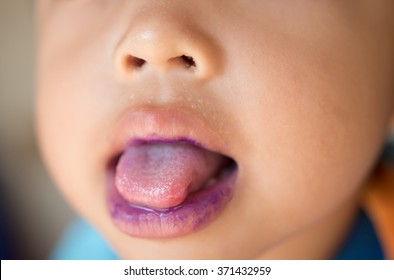 Hand Foot Mouth Disease In Child