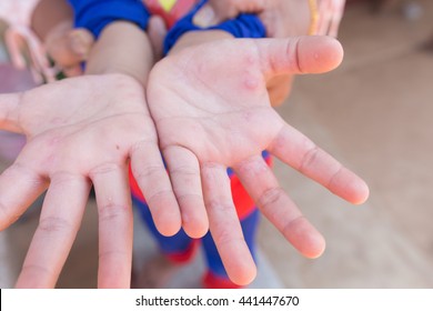 Hand Foot And Mouth Disease In Child