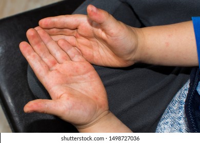 Hand foot mouth disease - childs hands.
