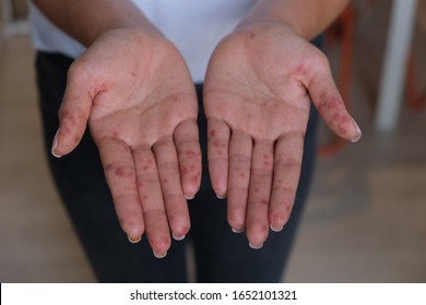 Hand foot and mouth disease or HFMD, caused by a virus. Close up of infected female hands.