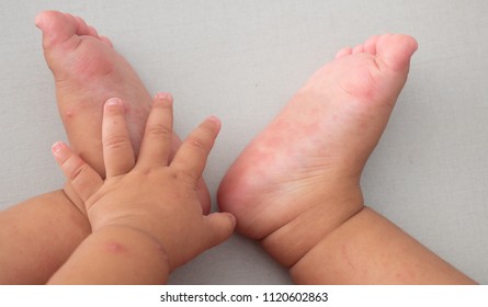 Hand, Foot And Mouth Disease Of Kid