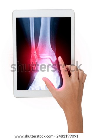 A hand gestures towards a tablet displaying an X-ray of an ankle showing a fibula bone fracture  isolated on white background. Clipping path.