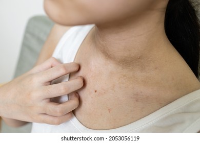 Hand Of Girl Scratching Skin,red Rash From Hot Weather,sweat Allergy,asian Woman With Itchy Skin,itch Rash On Her Chest And Neck,sensitive Skin,concept Of Dermatitis,health Care,skin Disease Problems