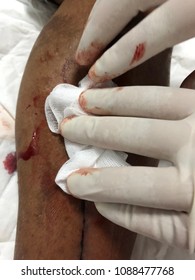 Hand holding with gloves and stop bleeding of wound left leg. Medical and healthcare concept.