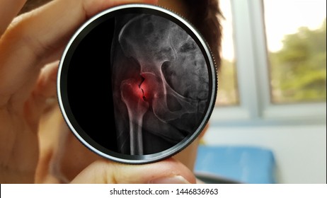 Doctor‘s Hand Holding Magnified Lens And Its Reflex Show Film X Ray Of Broken Hip Bone (neck Of Femur Fracture). The Old Patient Has Osteoporosis And Accidental Fall At Home. Fall Prevention Concept 