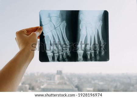 Hand holding an x-ray roentgen with a broken male foot.