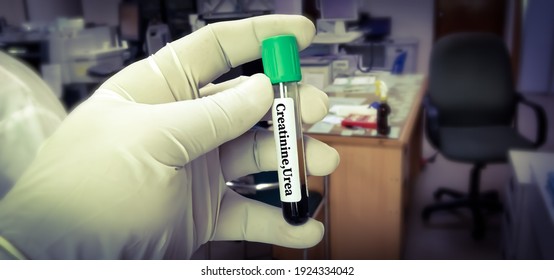 Hand Holds Test Tube With Blood For Blood Urea Nitrogen (BUN) Test.