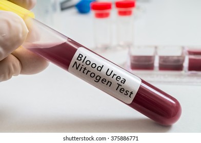 Hand Holds Test Tube With Blood For Blood Urea Nitrogen (BUN) Test.