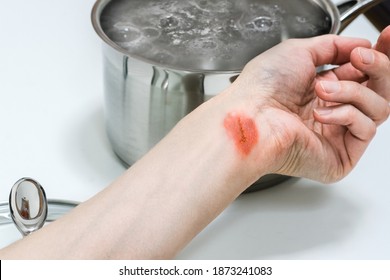Woman’s hand with injuries near the pot with boiling water, burns of skin,  home accident concept, careless behavior with boiling water and hot steams, scalds on a skin