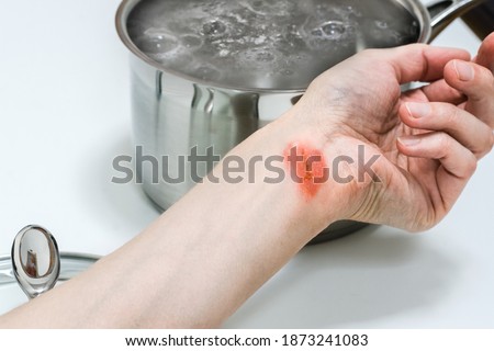 Woman’s hand with injuries near the pot with boiling water, burns of skin,  home accident concept, careless behavior with boiling water and hot steams, scalds on a skin