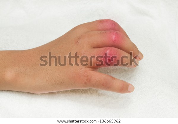 Hand
Injury  after car accident severed  closed fracture 2-4 finger,
Patient demonstrating surgery wound and
deformity