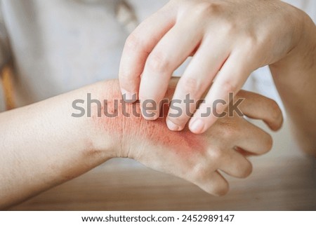hand itching scratching. Itchy red rash, flea allergies, blister fungal annoying skin diseases