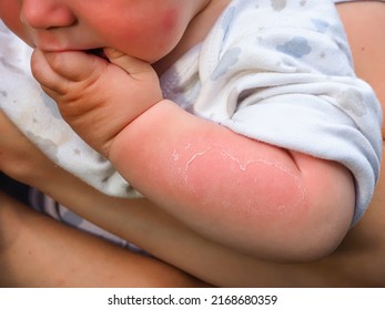 Hand Kid Baby Skin Close Up Sunburn Peeling Of The Skin On The Arm Of A Baby