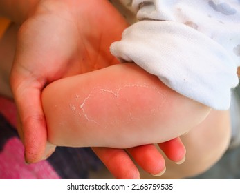 Hand Kid Baby Skin Close Up Sunburn Peeling Of The Skin On The Arm Of A Baby