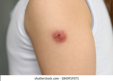 Hand Of A Kid With A Reaction To The BCG Vaccine